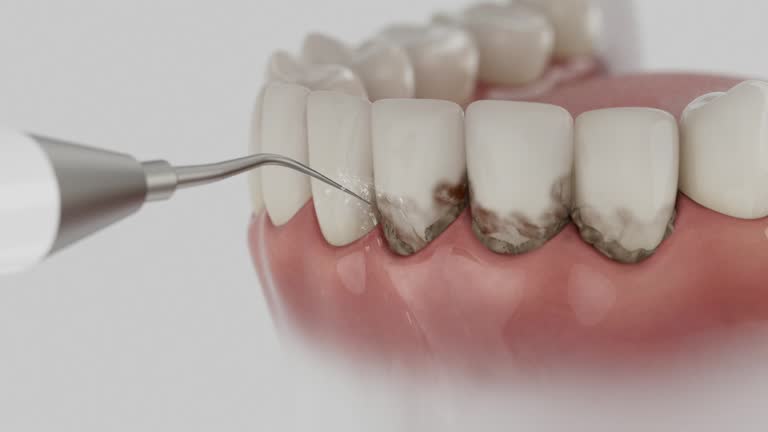 Trusted Wisdom Tooth Removal service in Caruthers, CA - Dentist Open Now